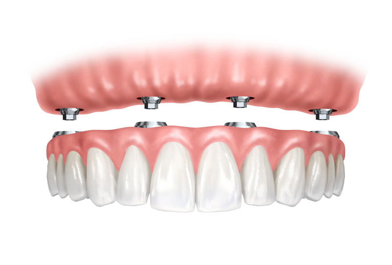 Woodstock dentist - dental implants - supported denture section 
