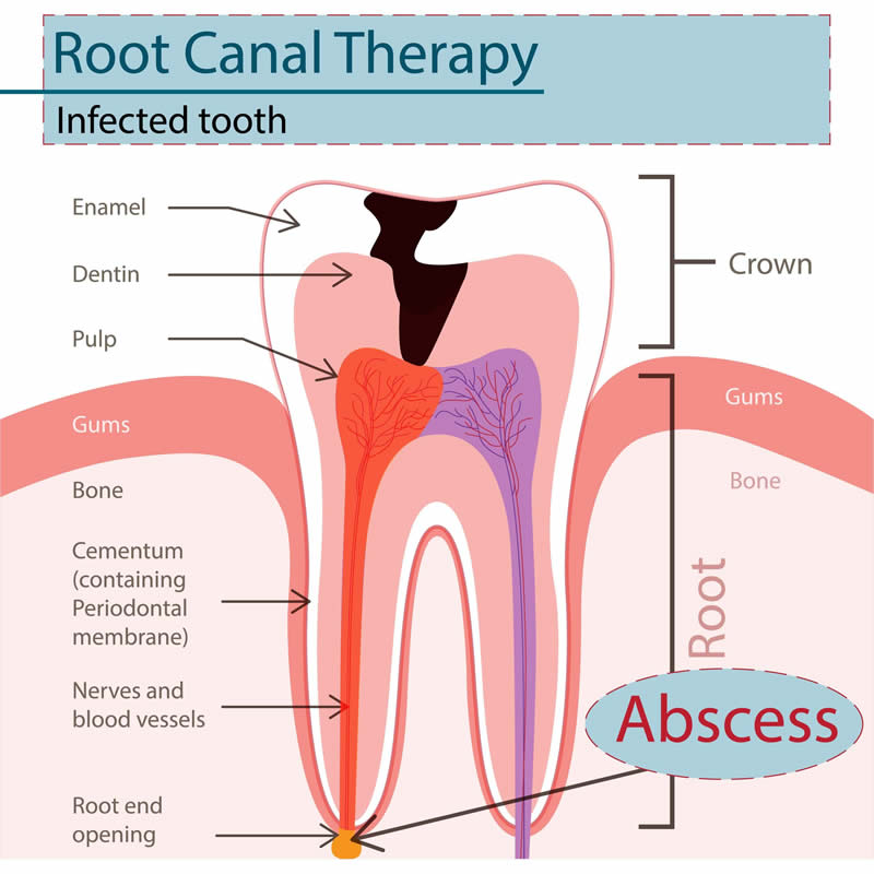 Oral Surgery - Root Canal Therapy (Endodontic)