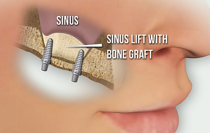 Oral Surgery - Sinus Lift with bone graft illustration