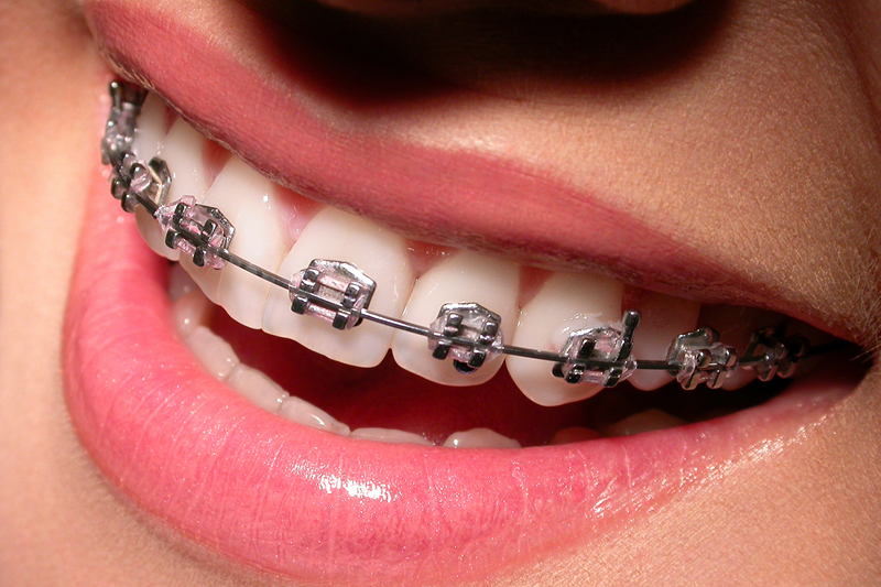 Orthodontics - Traditional Braces image