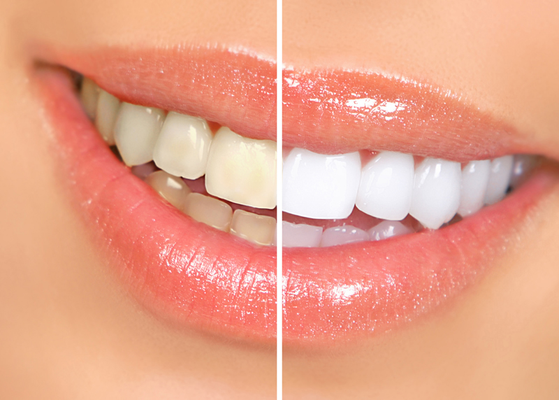 Woodstock dentist - Teeth Whitening - before and after image
