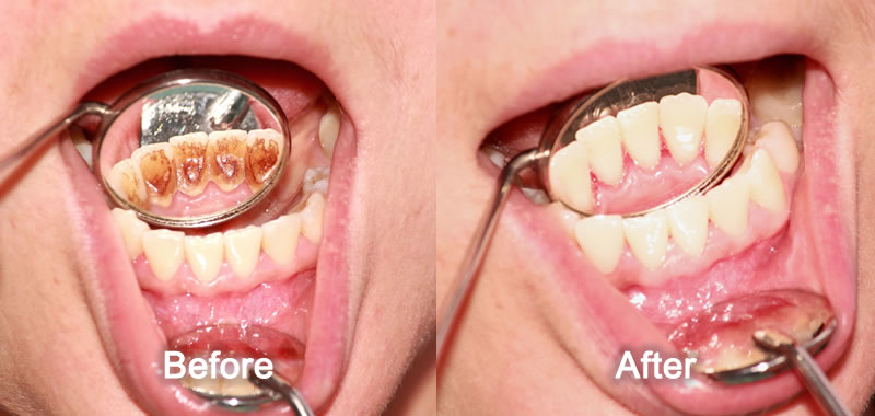 Woodstock Dentist - Smile Gallery - Dental Cleaning