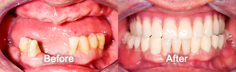 Woodstock Dentist - Smile Gallery - Dentures
