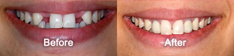 Woodstock Dentist - Smile Gallery - Dental Implants