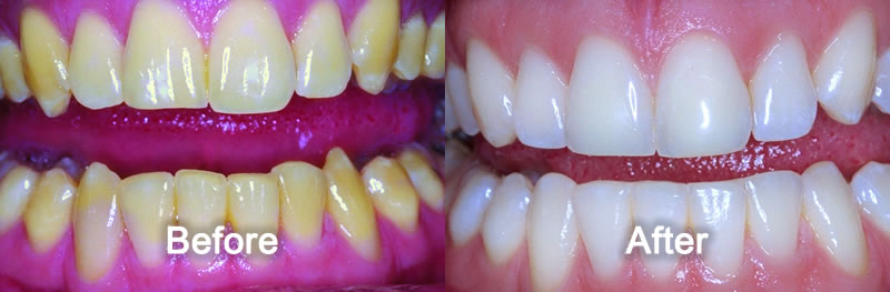 Woodstock Dentist - Smile Gallery - Teeth Whitening