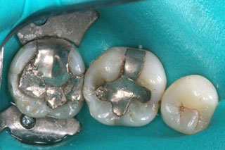 Woodstock Dentist - Amalgam Removal