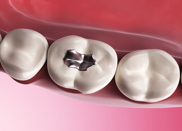 Safe Amalgam Removal - Tooth with Mercury Amalgam/Silver Filling
