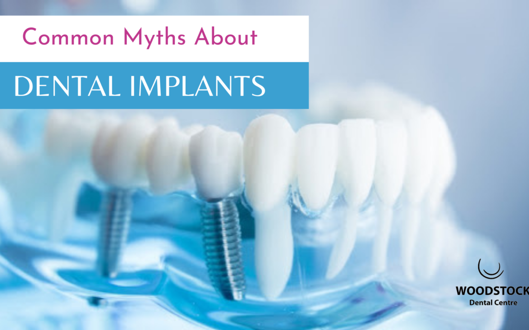 Myths about dental implants- Woodstock dentist