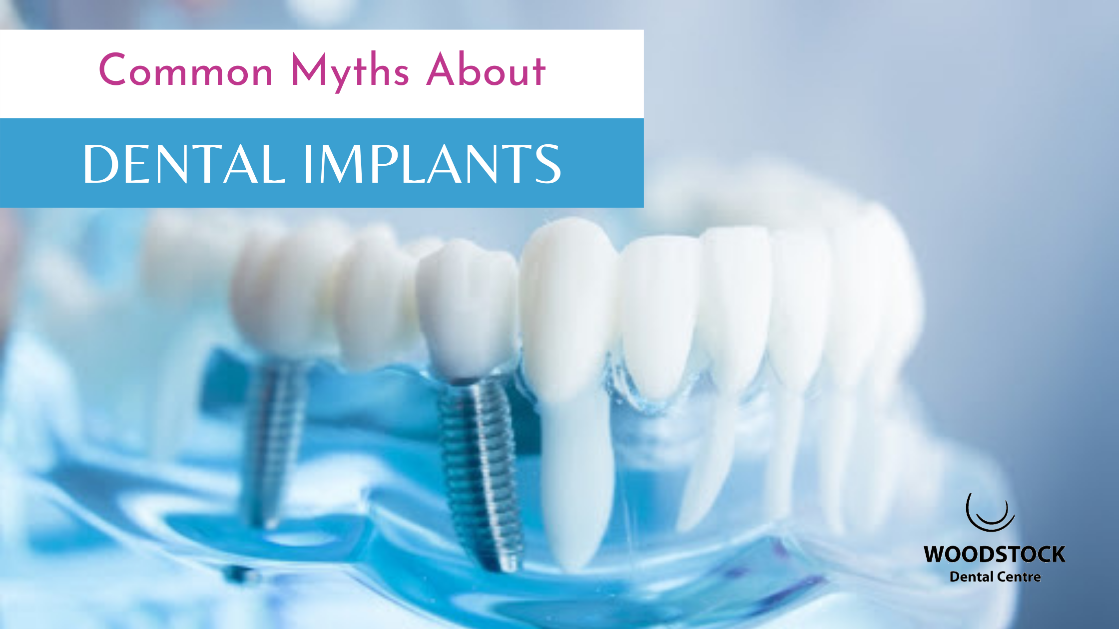 Common Myths About Dental Implants Woodstock Dental Centre