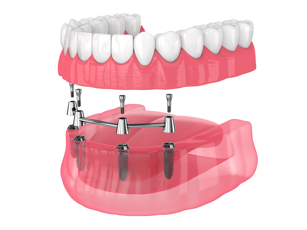 Dental Implants -Supported Dentures 