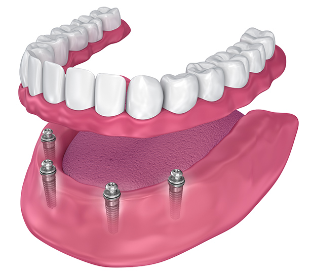 Dental Implants -Supported Dentures 