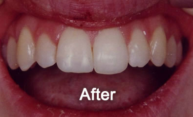 Woodstock Dentist | Cosmetic Bonding | After