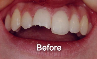 Woodstock Dentist | Cosmetic Bonding | Before