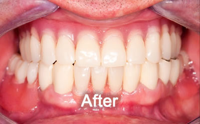 Woodstock Dentist | Dentures | After