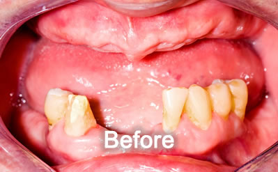 Woodstock Dentist | Dentures| Before