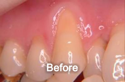 Woodstock Dentist | Gum Grafting | Before