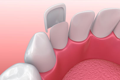 Woodstock Dentist | Porcelain Veneers