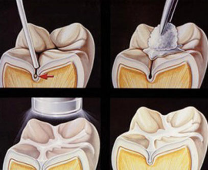 Woodstock Dentist | Childrens Dentistry | Dental Sealants