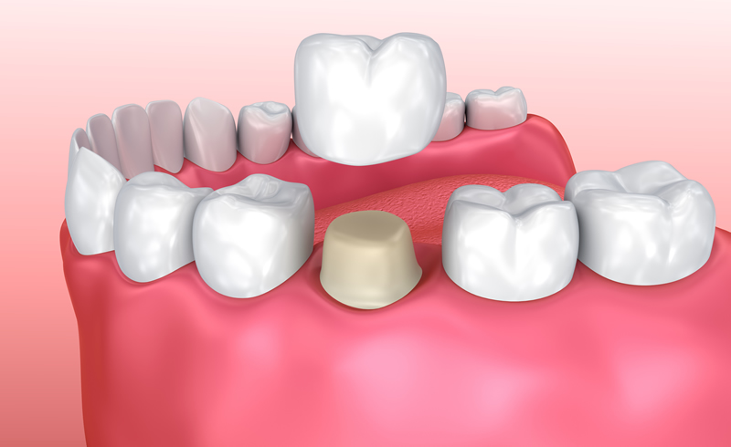Woodstock Dentist - Crowns-Bridges-Dentures - Crowns Restoration