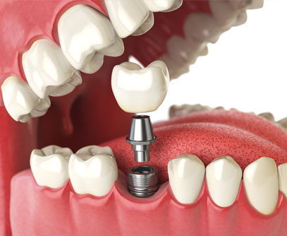 Illustration showing a crown being placed onto a dental implant in the mouth