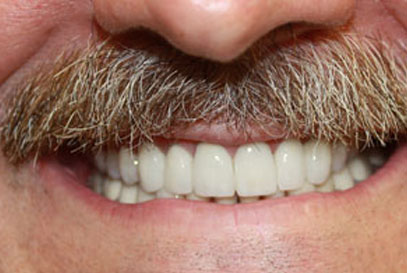 Woodstock Dentist | Full-Mouth Makeover | After