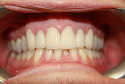 Woodstock Dentist | Full-Mouth Makeover | After