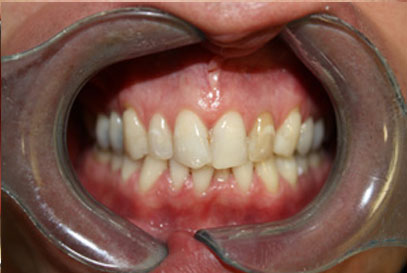 Woodstock Dentist | Full-Mouth Makeover | Before