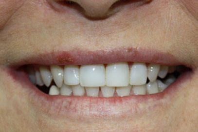 Woodstock Dentist | Full-Mouth Makeover | After