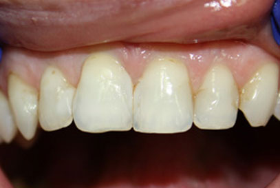 Woodstock Dentist | Full-Mouth Makeover | Before