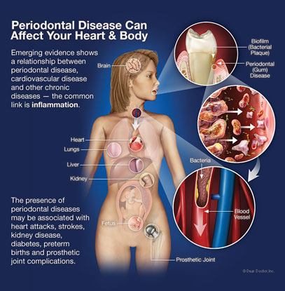 Woodstock Dentist-Gum Disease Therapy