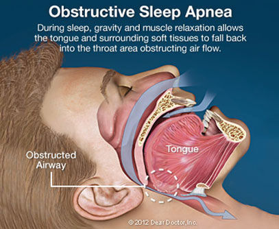 Woodstock Dentist | Obstructive Sleep Apnea