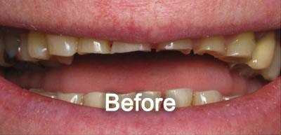 Woodstock Dentist | Porcelain Veneers | Before