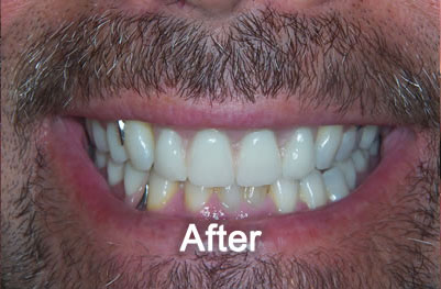 Woodstock Dentist | Smile Makeover | After