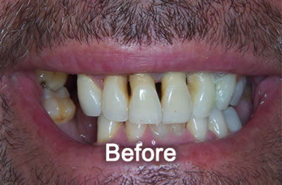 Woodstock Dentist | Smile Makeover | Before