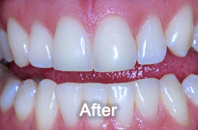 Teeth-Whitening-After