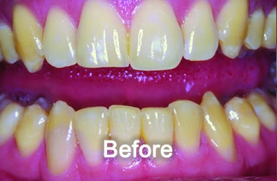 Woodstock Dentist | Teeth Whitening | Before