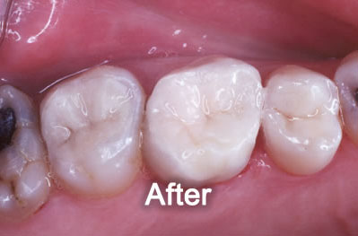 Woodstock Dentist | White-Fillings | After