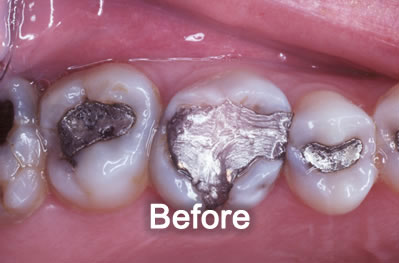 Woodstock Dentist | White-Fillings | Before