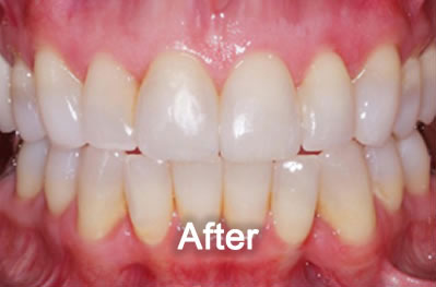 Woodstock Dentist | Invisalign | After