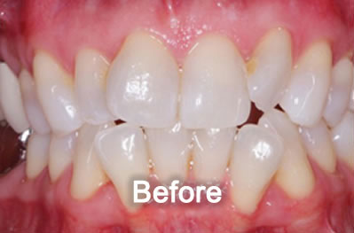 Woodstock Dentist | Invisalign | Before