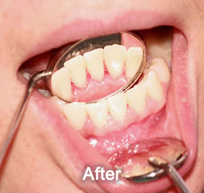 Woodstock Dentist | Dental Cleaning | After