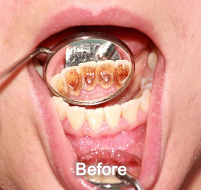 Woodstock Dentist | Dental Cleaning | After