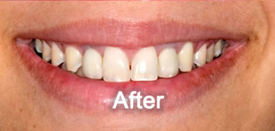 Woodstock Dentist | Dental Implants | After