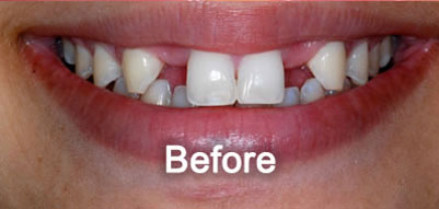 Woodstock Dentist | Dental Implants | Before