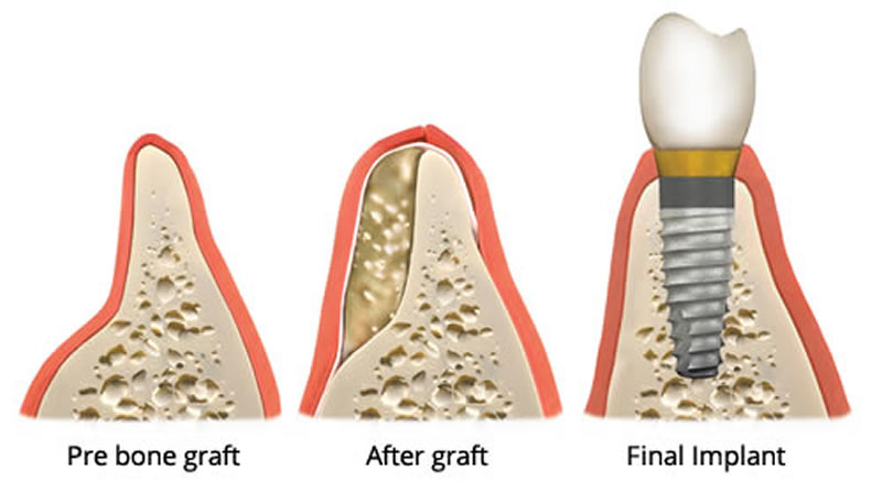 Oral Surgery - Bone Grafts - Illustration