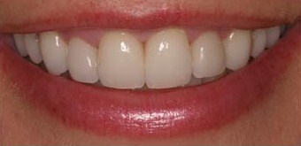 Oral Surgery - Periondontal - After photo