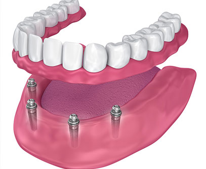 Illustration of a lower denture attached to dental implants in the jaw
